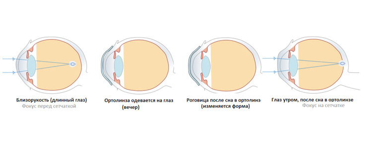 как работают ортокератологические линзы